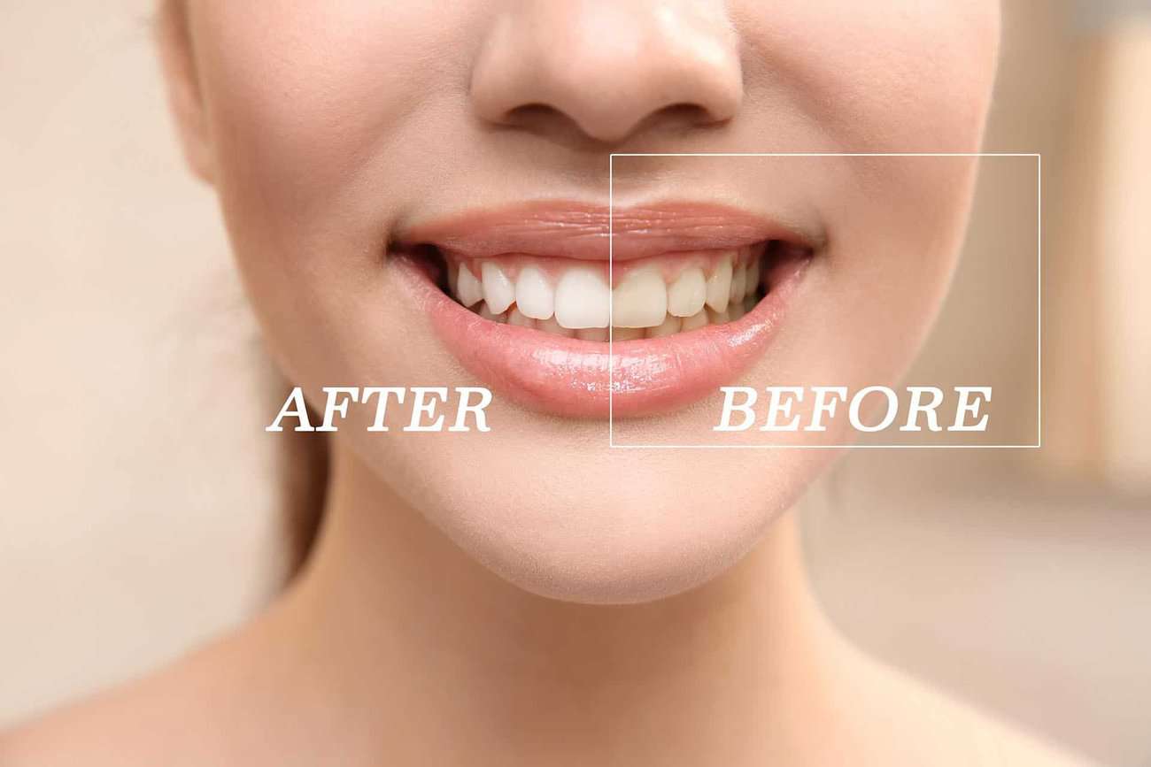 What Are the Most Effective Natural Teeth Whitening Methods You Can Try Hartlepool?