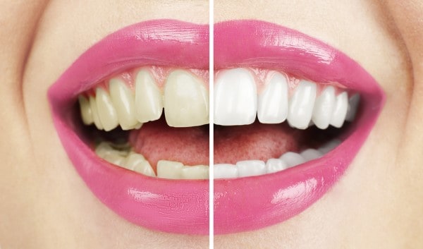 What Early Signs of Oral Cancer Should You Never Ignore Hartlepool?