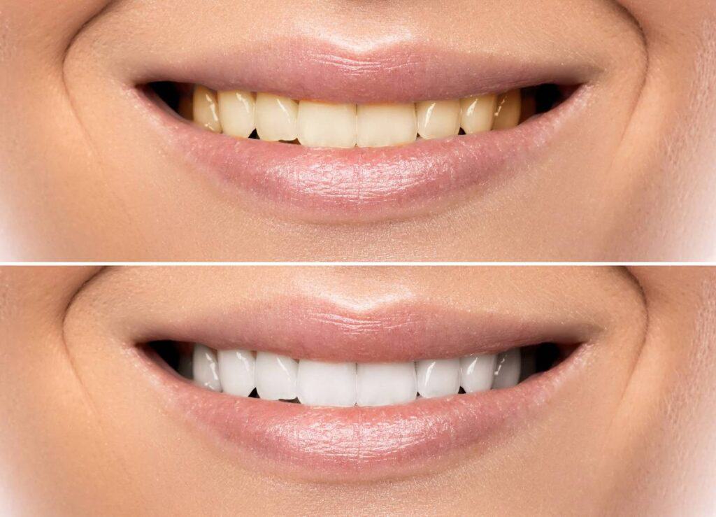 How Can You Protect Your White Smile as a Coffee Lover Hartlepool?