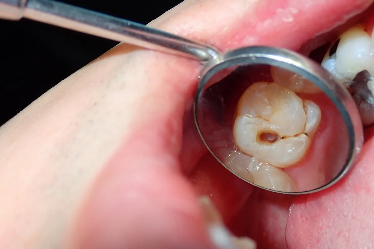 Why Do Teeth Crack? Common Causes to Know Hartlepool