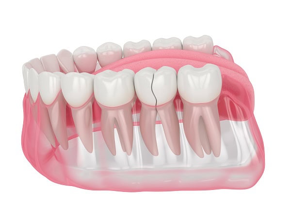 How Can You Manage Pain and Discomfort After a Root Canal Hartlepool?