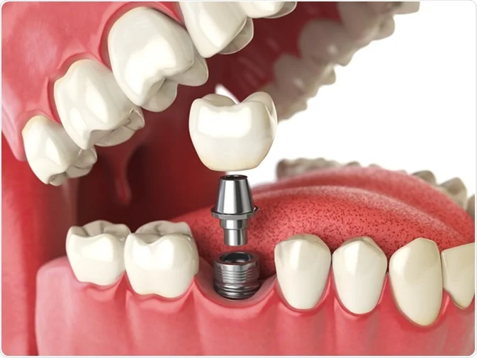 How Do I Decide Which Tooth Replacement Is Right for Me Hartlepool?