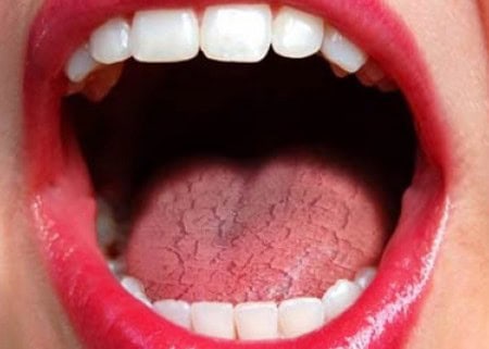 Dry Mouth and Its Role in Tooth Decay Hartlepool
