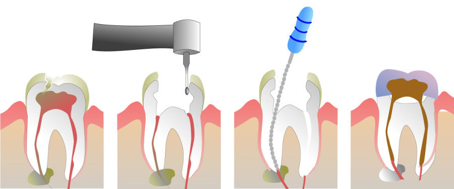 How Do You Properly Care for Your Teeth After a Root Canal Hartlepool