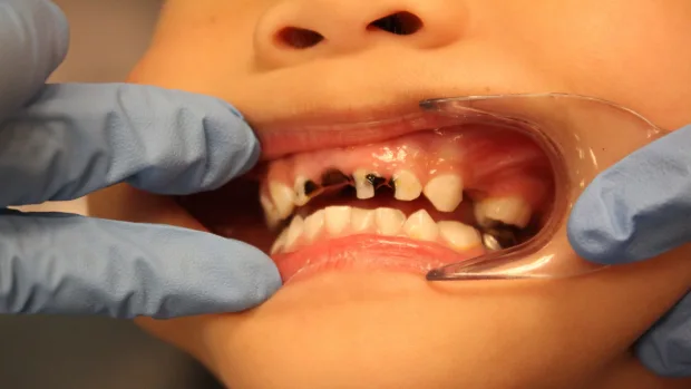 Which Foods and Drinks Cause the Most Damage to Young Smiles Hartlepool?
