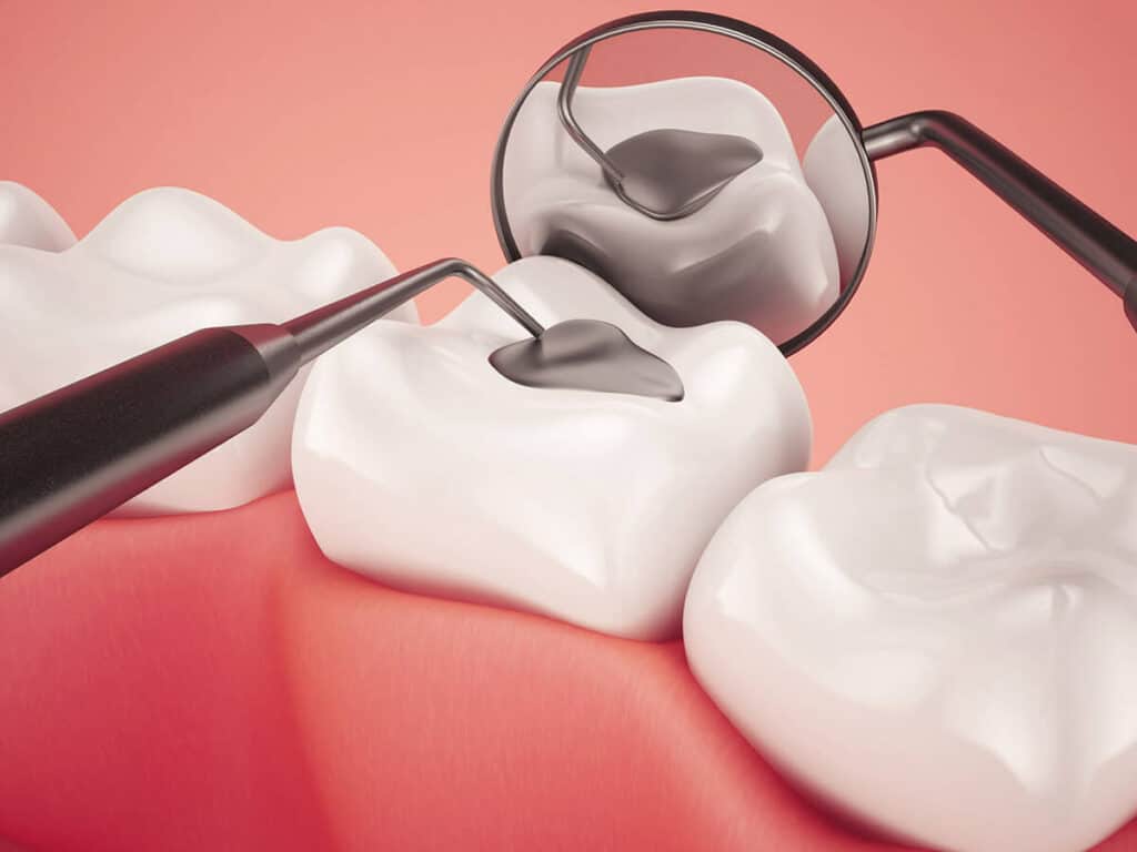 How Can You Prevent Tooth Decay Effectively Hartlepool