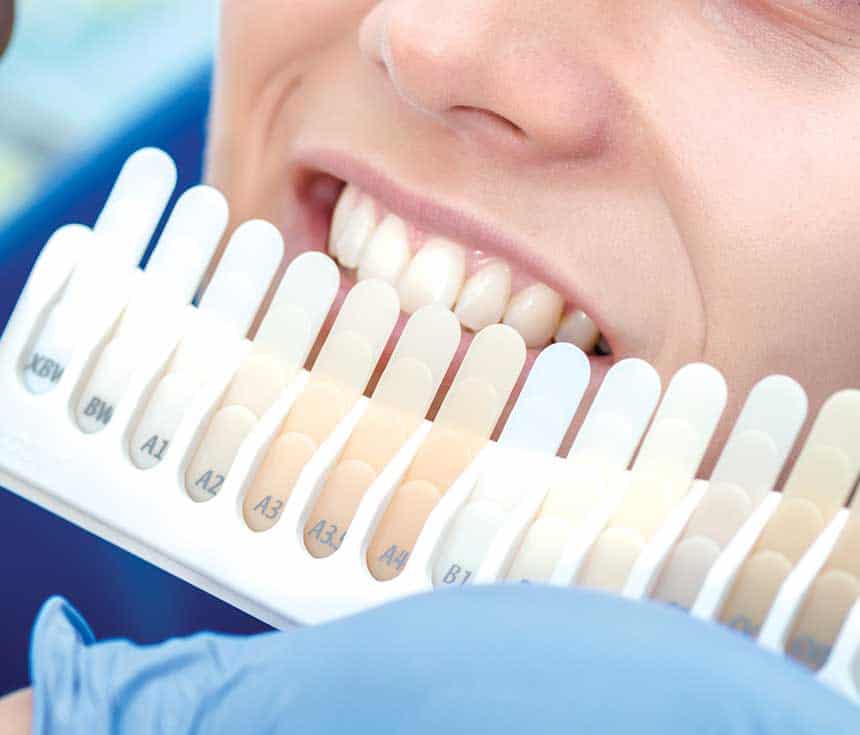 How Much Does One Laser Teeth Whitening Session Cost Hartlepool?