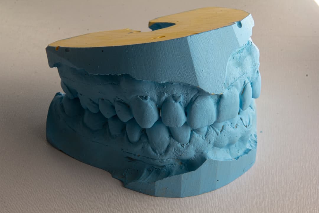 How Do Dental Implants Improve Jawbone Health and Oral Function Hartlepool?