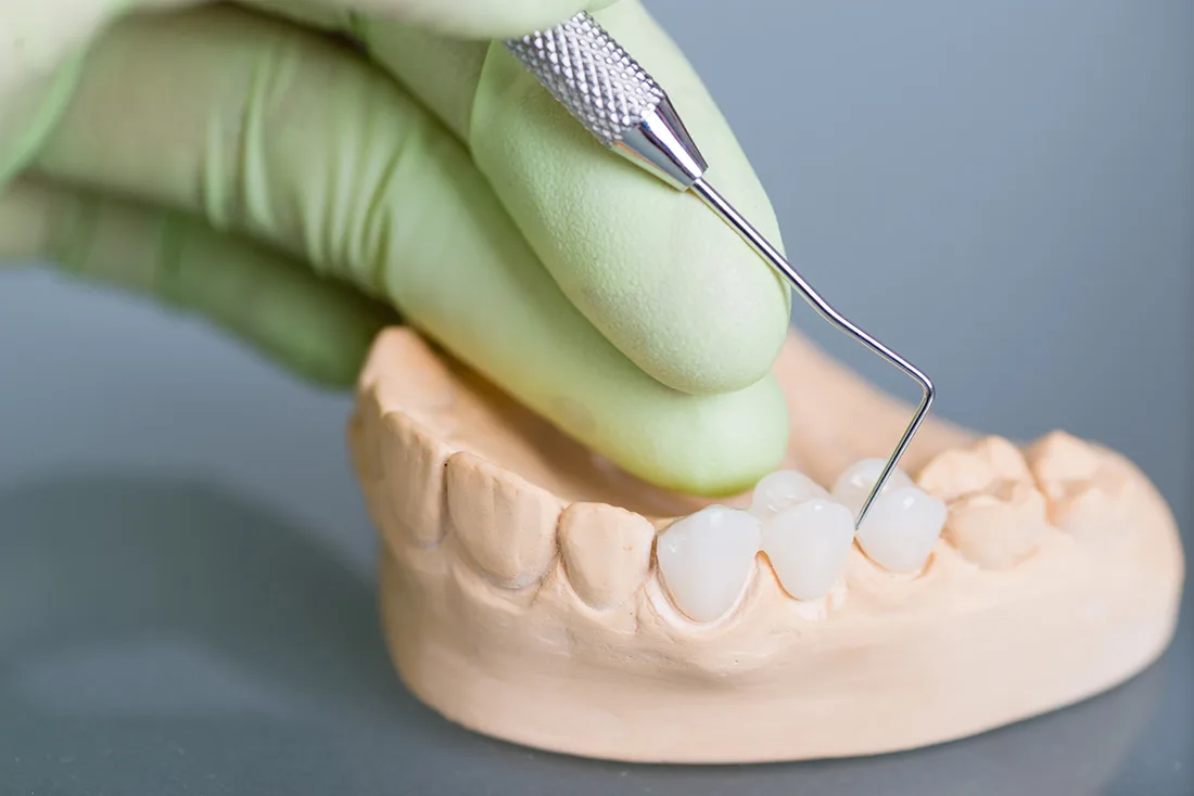 What Are the Different Types of Dental Crowns Available Hartlepool?