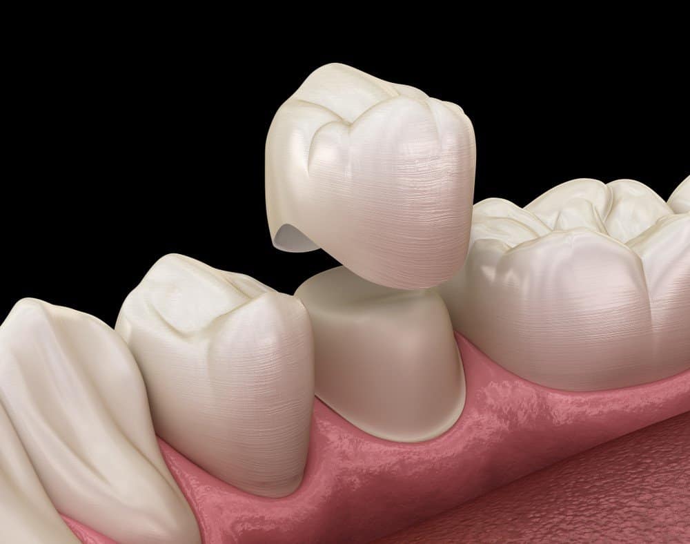 What is the Procedure for Getting Dental Implants Hartlepool?