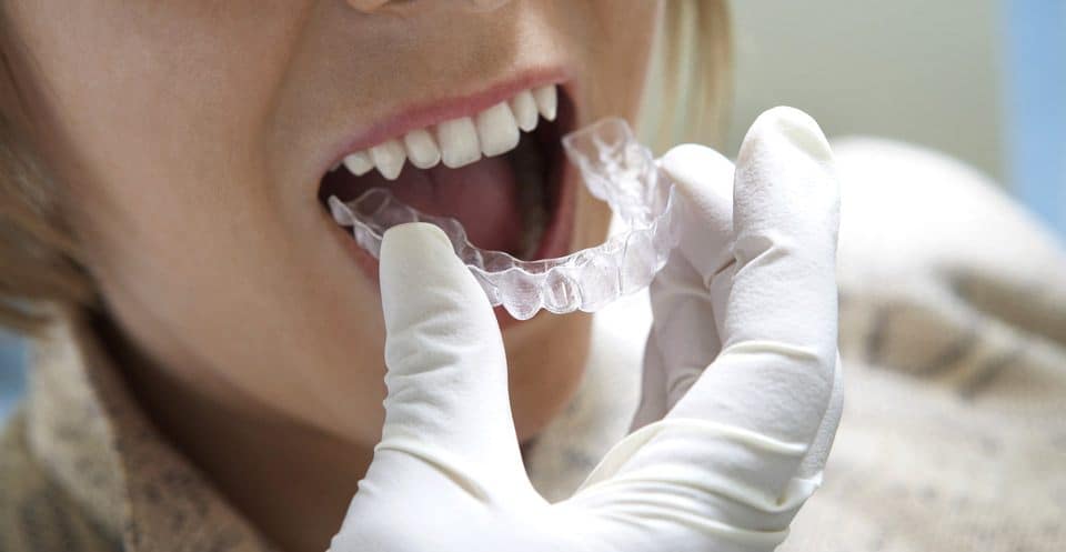How Much Does Laser Teeth Whitening Cost Compared to Overnight Trays Hartlepool?