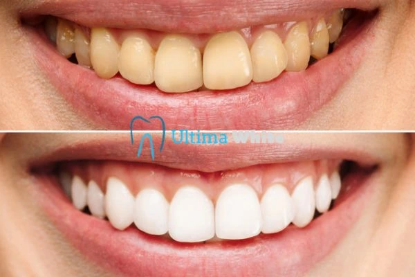 Essential Aftercare Tips to Protect Your Laser Teeth Whitening Results