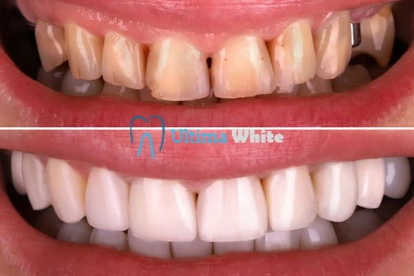 What Makes Instant Teeth Whitening Treatments So Popular Hartlepool?