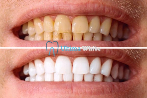 Stained Teeth and Persistent Bad Breath Hartlepool